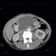 Small cell lung carcinoma, SCLC, metastasis in pancreas, after therapy: CT - Computed tomography